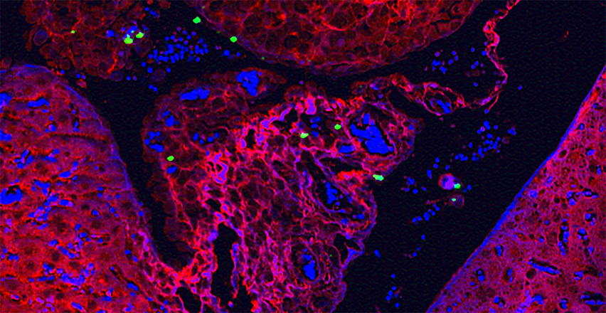 layered nanoparticles illuminating a microscopic tumor