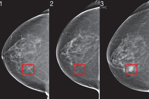 Three mammogram images, side by side, with a breast cancer lesion on the third slide. 