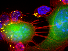 nanoparticle-laden T cells attacking melanoma tumor cells