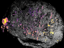 a tumor in grey with spots of vaccine highlighted in pink and yellow