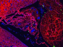 layered nanoparticles illuminating a microscopic tumor