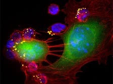 nanoparticle-loaded T cells interacting with melanoma tumor cells